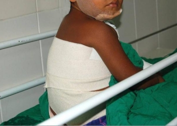 Niña de 4 años sufre quemaduras de segundo grado
