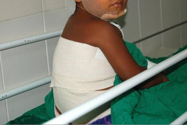 Niña de 4 años sufre quemaduras de segundo grado