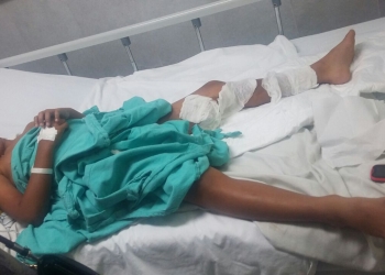 Menor se quema con botella de ácido