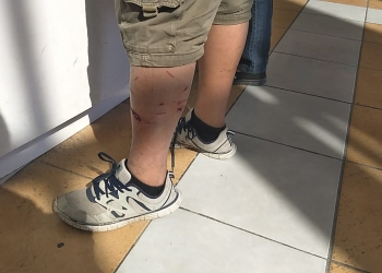 Joven es atacado por una perra de camino a su casa