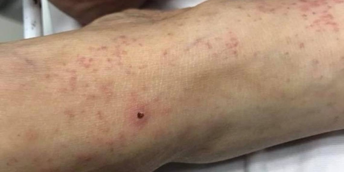 Van 15 muertes por rickettsia, transmitida por garrapatas, en Chihuahua