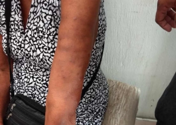 Reportan 4 casos de lepra en Chiapas; descartan alerta