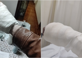 Ponen yeso a paciente en el IMSS y no se puede quitar su chamarra