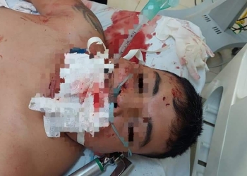 Realizan reconstrucción facial a motociclista lesionado