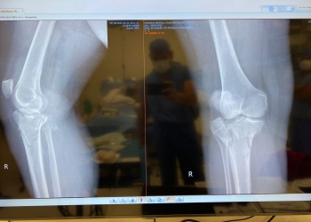 Mujer fracturada solicita ayuda para operación