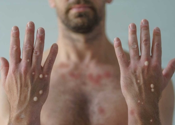 En últimos 14 días se confirman nueve casos de mpox en México